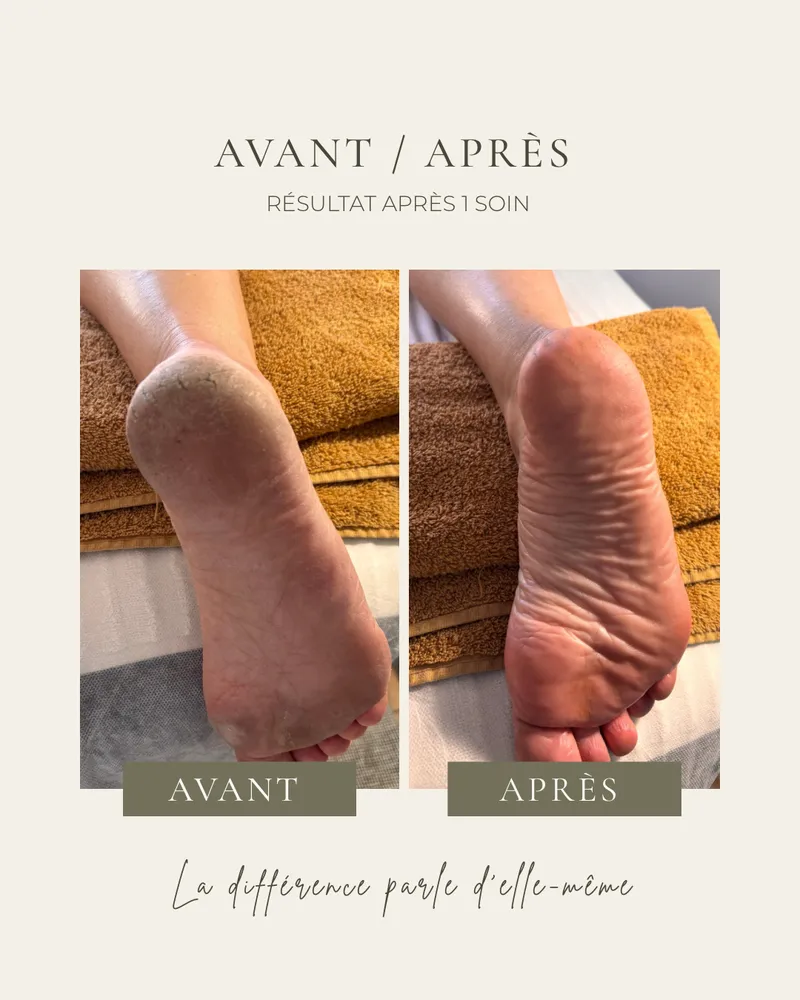Avant / après un soin Yummy Feet : un talon marqué de callosités, puis le même pied lisse après une séance